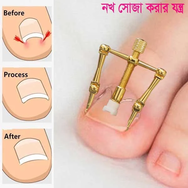 নখের কোনা সোজা করার অত্যাধুনিক যন্ত্র ( Nail Repair